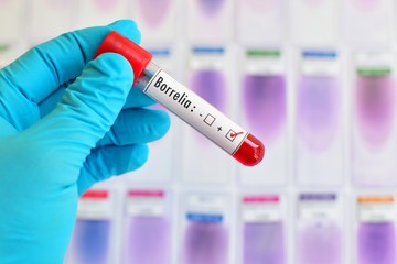 Blood sample positive with Borrelia test (Lyme disease diagnosis) 
