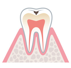 虫歯の進行