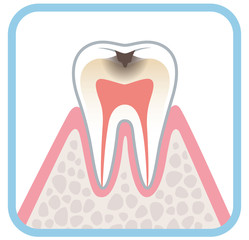 虫歯の進行