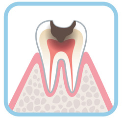 虫歯の進行