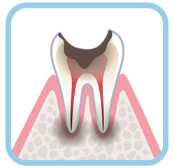 虫歯の進行