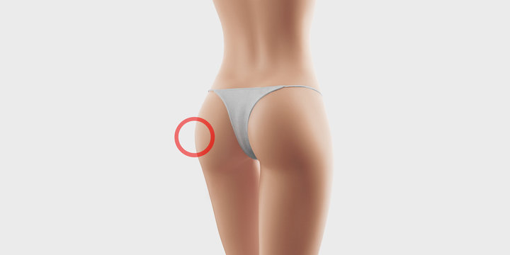 Sedere donna cellulite adipe 