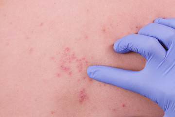 doctor pointing to Herpes zoster