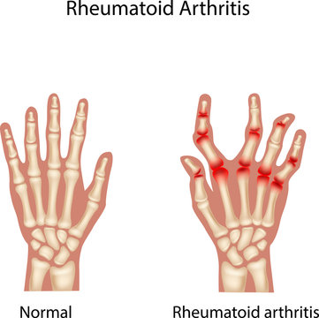 Illustration of Rheumatoid Arthi