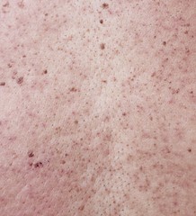 Fototapeta premium Girl with problematic skin and acne scars in the back