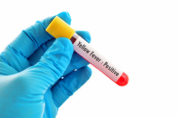 Obraz premium Blood sample positive with yellow fever test
