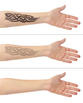 Naklejka Tattoo on male hand. Laser tattoo removal concept