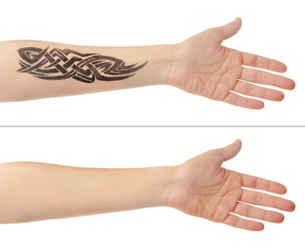 Naklejka Tattoo on male hand. Laser tattoo removal concept