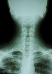 X-rays used in the treatment