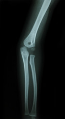 X-rays used in the treatment