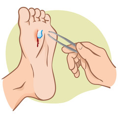 Person injured foot with broken glass, pulling with forceps, caucasian