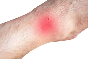 wound on foot injury