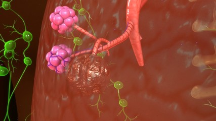 Granuloma