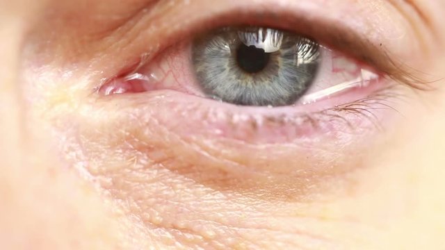  red eye with tears - close-up