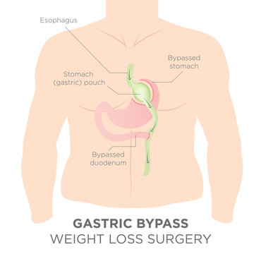 Gastric Bypass for Weight Loss - You Are Actually Re-routing Your Stomach in Order to Feel Full and Eat Less