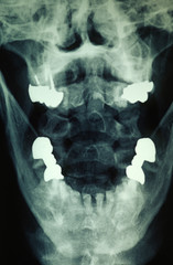 Röntgenbild: Zähne und Kiefer