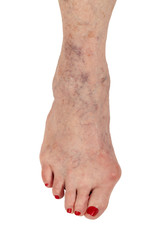 Fototapeta premium Medical: Female senior citizen right foot showing three medical conditions 