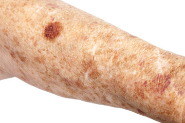 Female senior citizen arm with age spots (also known as liver spots, Solar lentigo, Lentigo senilis and Senile freckle) shot on a white background. 
