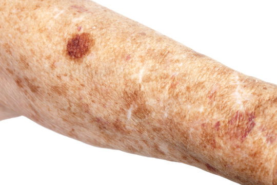 645 Best Liver Spots Images Stock Photos Vectors Adobe Stock 645 Best Liver Spots Images Stock Photos Vectors Adobe Stock