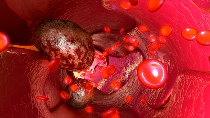 Tumour cells in blood vessels