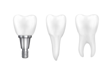 Tooth implants and normal tooth isolated on white background