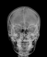skull x-rays image sagital plane