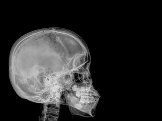 skull x-rays image sagital plane