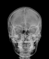 Fototapeta na wymiar skull x-rays image sagital plane