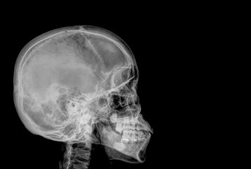 skull x-rays image sagital plane