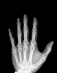 Human hand x-ray - Medical Image.