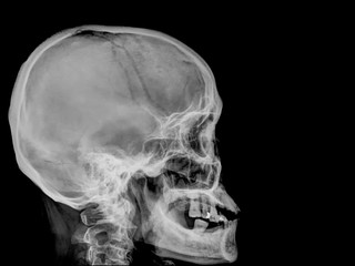 skull x-rays image sagital plane
