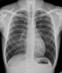 View of a human x-ray film, taken to examine the lungs