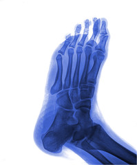 x-ray of foot
