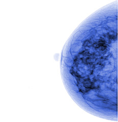 X-ray mammogram image of breast with cancer
