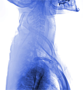 Xray of neck and cervical spine, side view.