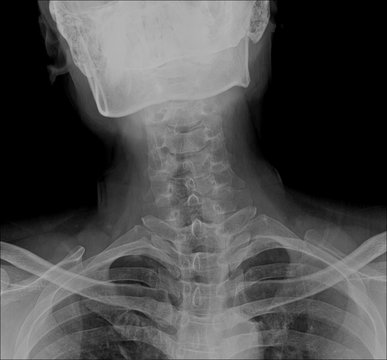 Xray of neck and cervical spine, front view.
