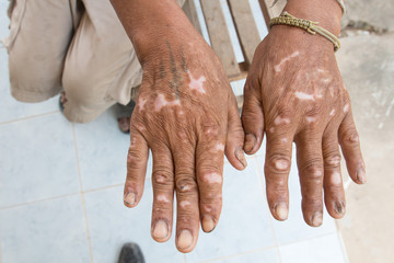 Skin disorder