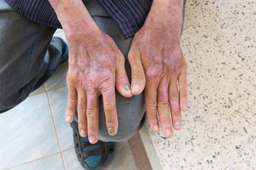 Skin disorder in back hand