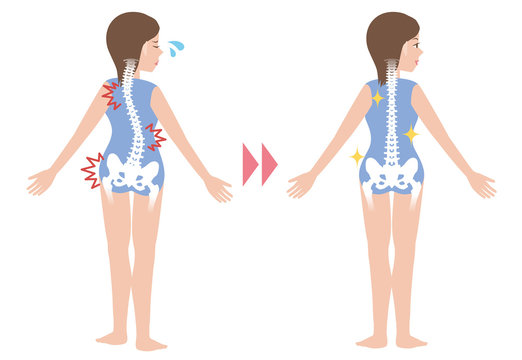 chiropractic before after image, from bad posture to good posture, woman's body and backbone, vector illustration