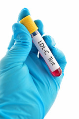 Obraz premium LDL cholesterol (LDL-C) test 