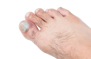 bruised on toenail