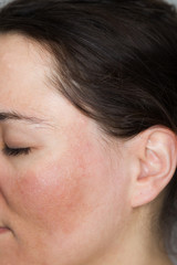 Fototapeta premium Junge Frau mit Pigmentflecken und unreiner Haut