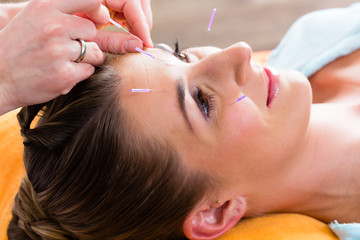 Therapist setting acupuncture needles - obrazy, fototapety, plakaty
