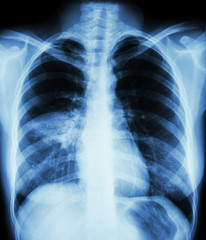 Pneumonia ( film chest x-ray show alveolar infiltrate at right middle lung ) ( image for pulmonary...