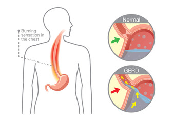 Picture of human stomach in problem area have acid back up into esophagus which is cause gastroesophageal reflux disease.