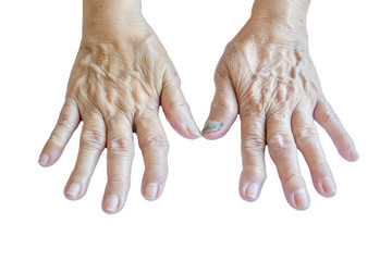 hands Osteoarthritis of an old woman