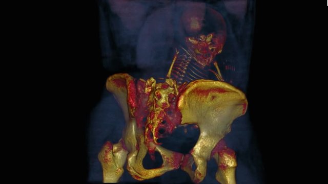Fetus in uterus