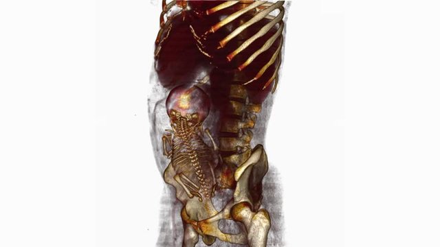 Full term pregnancy with fetus in breech position