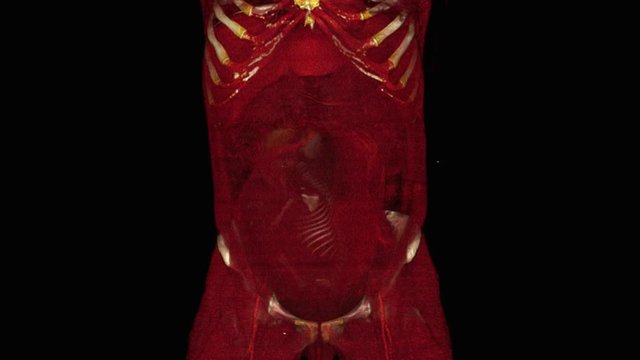 Full term pregnancy with fetus in breech position