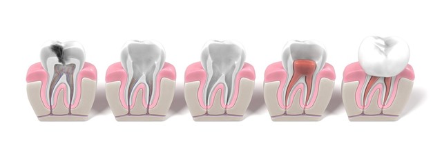 3d renderings of endodontics - root canal procedure - obrazy, fototapety, plakaty